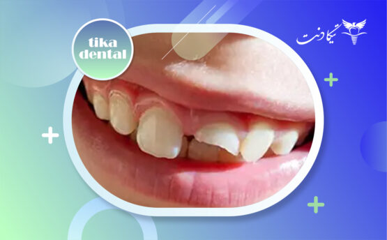 ترمیم دندان شیری