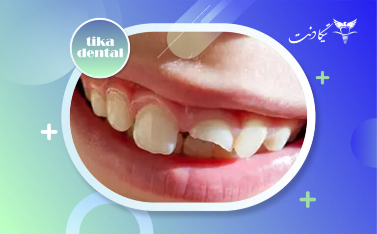 ترمیم دندان شیری