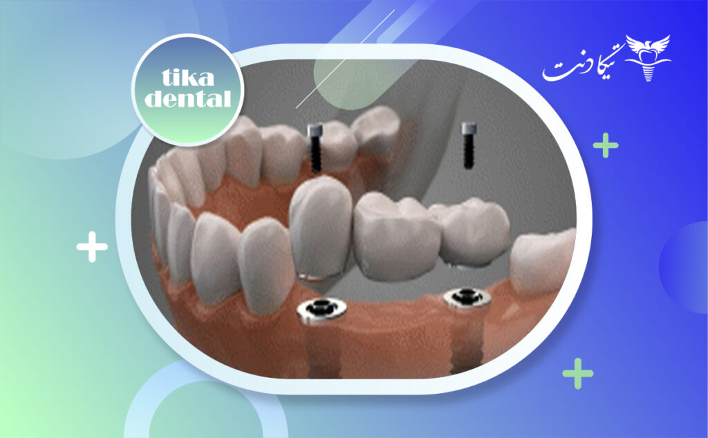 معایب و عوارض ایمپلنت دیجیتال