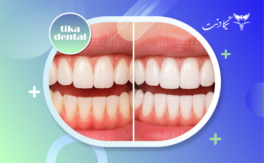 تفاوت لمینت سرامیکی و کامپوزیتی