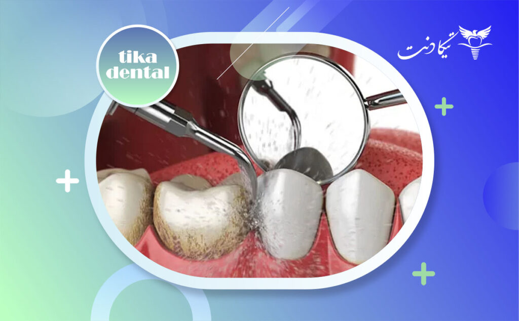 جرمگیری ایمپلنت دندان