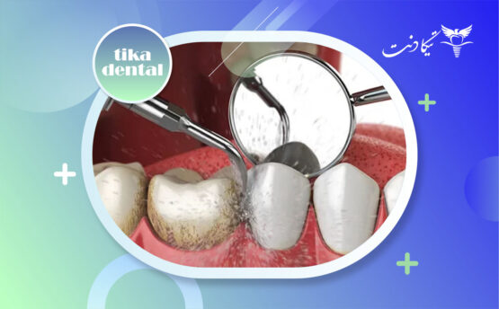 جرمگیری ایمپلنت دندان