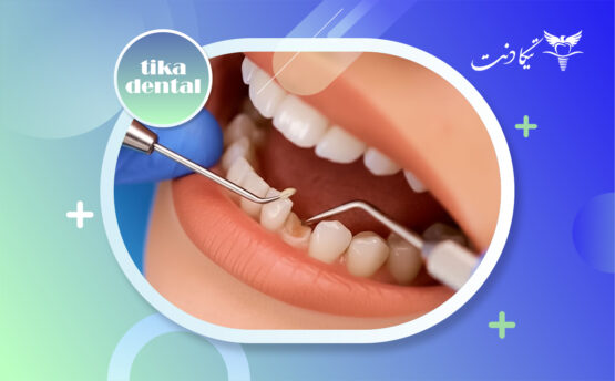 لب پر شدن کامپوزیت دندان