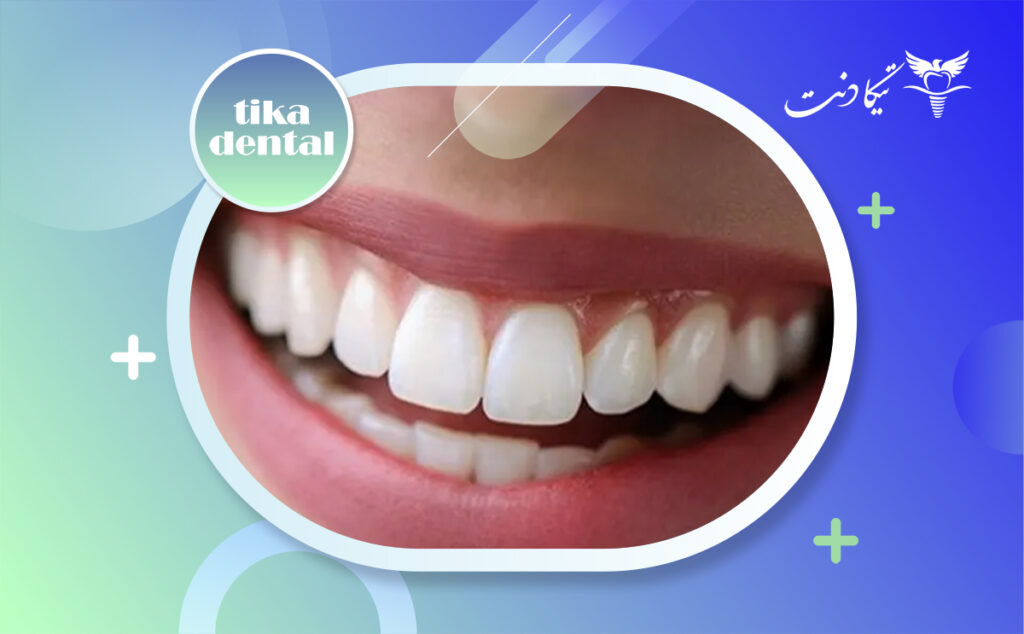 لمینت دندان خرگوشی