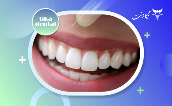 لمینت دندان خرگوشی