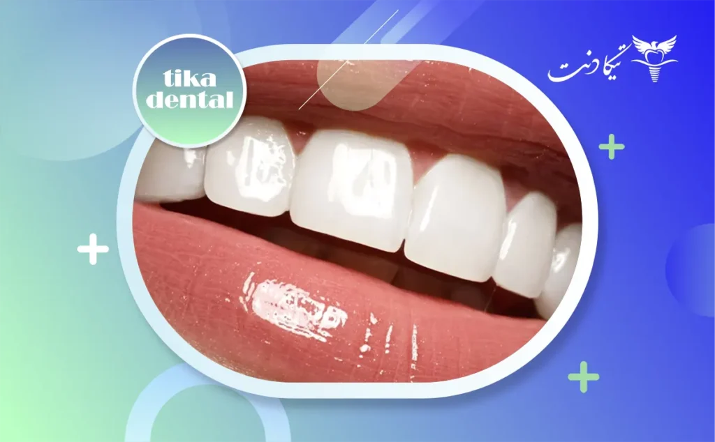 لمینت دندان چیست