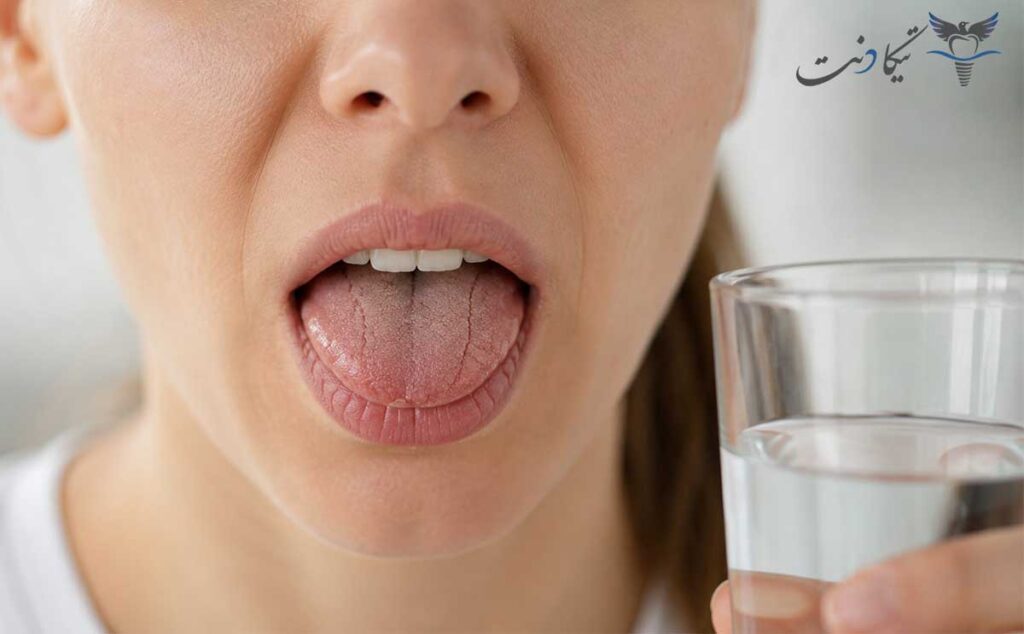 علت خشکی دهان بعد از کامپوزیت