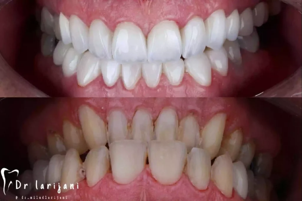 نمونه کار لمینت دندان تیکادنتال