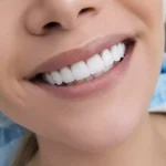 نمونه کار کامپوزیت دندان