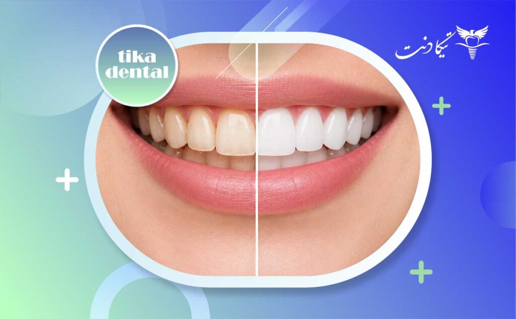 تفاوت بلیچینگ و کامپوزیت