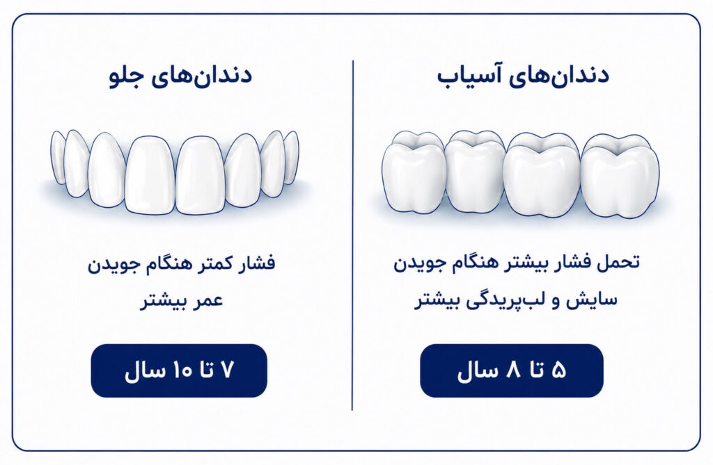 عمر کامپوزیت دندان های جلو در مقابل دندان های آسیاب