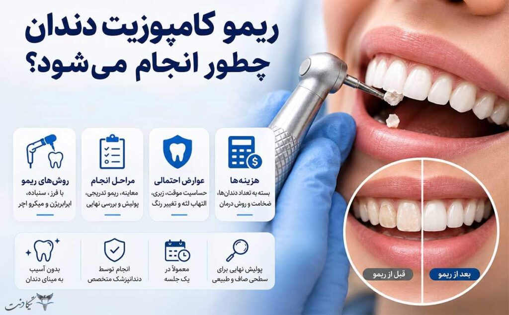ریمو کامپوزیت