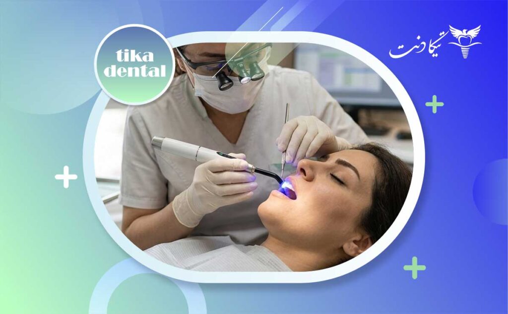 کامپوزیت روی روکش دندان