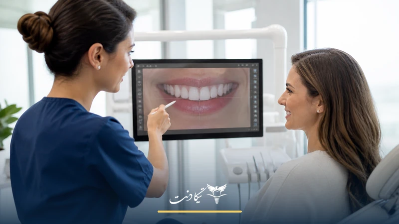عوارض لمینت دندان